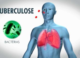 Tuberculose Maintenir le cap pour éradiquer la maladie