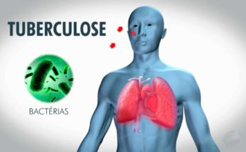 Tuberculose Maintenir le cap pour éradiquer la maladie