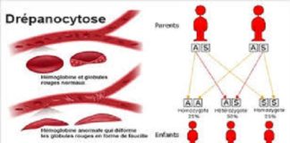 Drépanocytose: National Institutes of Health prévoit d’investir au moins 100 millions de dollars