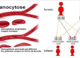 Drépanocytose: National Institutes of Health prévoit d’investir au moins 100 millions de dollars