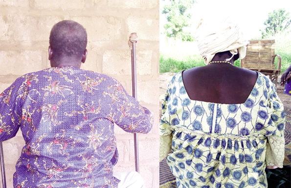 Handicap et VIH : «Personne ne veut s’approcher de moi»