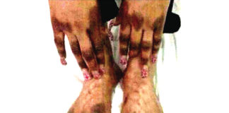 Pr Augustin Palé, anthropologue : «La dépigmentation s’inscrit dans une problématique complexe »