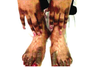 Pr Augustin Palé, anthropologue : «La dépigmentation s’inscrit dans une problématique complexe »