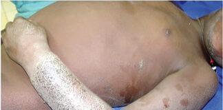 Troubles dermatologiques : « La dermatite atopique altère la qualité de vie de l’enfant », Dr Patrice Tapsoba