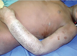 Troubles dermatologiques : « La dermatite atopique altère la qualité de vie de l’enfant », Dr Patrice Tapsoba