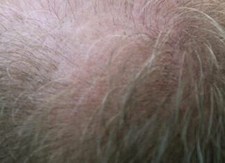 Calvitie : Des chercheurs américains auraient trouvé la solution pour combattre la chute des cheveux