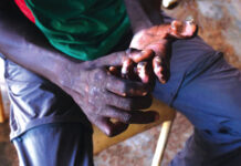 La lèpre : une pathologie qui résiste au temps