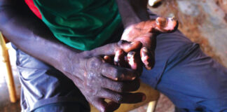 La lèpre : une pathologie qui résiste au temps