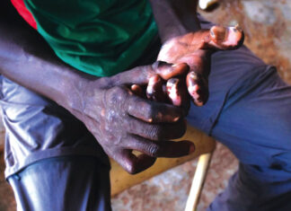 La lèpre : une pathologie qui résiste au temps