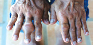 L’arthrite : les exercices physiques, un « remède »