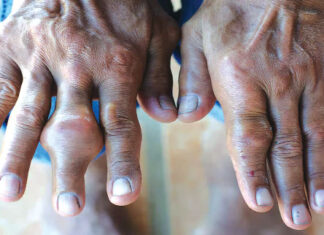 L’arthrite : les exercices physiques, un « remède »