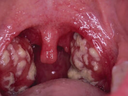 Pédiatrie : chez l’enfant, l’angine peut s’accompagner de troubles digestifs