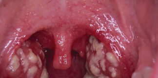 Pédiatrie : chez l’enfant, l’angine peut s’accompagner de troubles digestifs