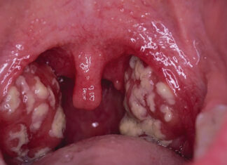 Pédiatrie : chez l’enfant, l’angine peut s’accompagner de troubles digestifs
