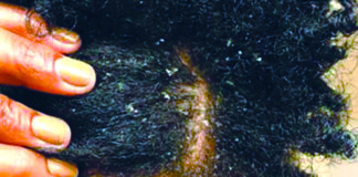 Pellicules dans les cheveux : « Elles peuvent cacher une maladie grave », Dr Angèle Ouangré, dermatologue