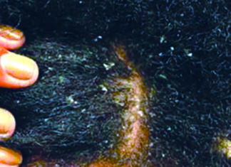 Pellicules dans les cheveux : « Elles peuvent cacher une maladie grave », Dr Angèle Ouangré, dermatologue