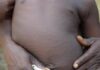 Burkina Faso : 1269 cas suspects de rougeole détectés