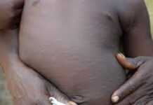 Burkina Faso : 1269 cas suspects de rougeole détectés