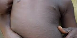 Burkina Faso : 1269 cas suspects de rougeole détectés