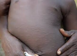 Burkina Faso : 1269 cas suspects de rougeole détectés