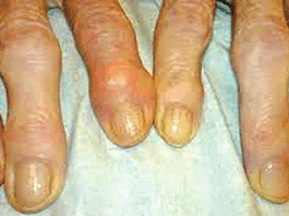 L’Arthrose: l’articulation atteinte peut se déformer et perdre sa mobilité