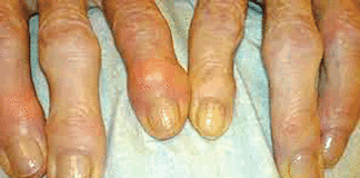 L’Arthrose: l’articulation atteinte peut se déformer et perdre sa mobilité