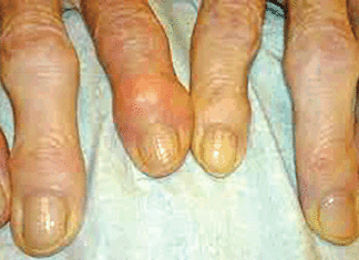 L’Arthrose: l’articulation atteinte peut se déformer et perdre sa mobilité