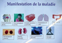 Système immunitaire de l’organisme : le lupus, une maladie silencieuse et pernicieuse peu connue