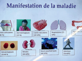 Système immunitaire de l’organisme : le lupus, une maladie silencieuse et pernicieuse peu connue