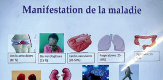 Système immunitaire de l’organisme : le lupus, une maladie silencieuse et pernicieuse peu connue