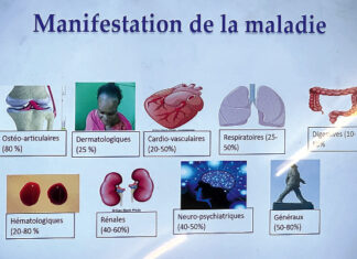 Système immunitaire de l’organisme : le lupus, une maladie silencieuse et pernicieuse peu connue