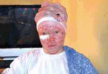 Elèves atteints d’albinisme: le décrochage scolaire, un frein aux efforts d’éducation