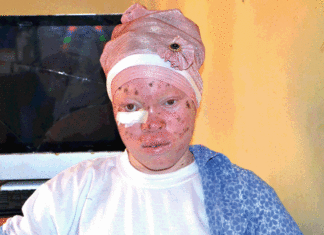 Elèves atteints d’albinisme: le décrochage scolaire, un frein aux efforts d’éducation