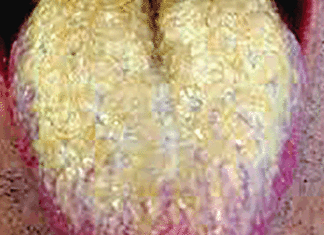 Langue blanchâtre ou langue saburrale : respecter une bonne hygiène bucco-dentaire