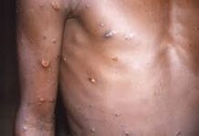 OMS : 15 000 cas et 461 décès liés au virus variole du singe (mpox)