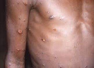 OMS : 15 000 cas et 461 décès liés au virus variole du singe (mpox)