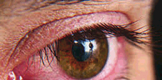 Sécheresse oculaire: la détérioration de votre vision, une sérieuse alerte