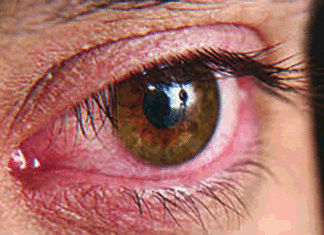 Sécheresse oculaire: la détérioration de votre vision, une sérieuse alerte