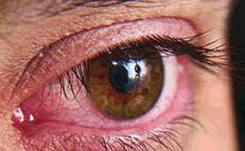 Sécheresse oculaire: la détérioration de votre vision, une sérieuse alerte