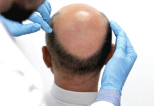 Alopécie : des mesures simples pour éviter la chute des cheveux