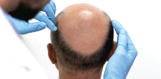 Alopécie : des mesures simples pour éviter la chute des cheveux