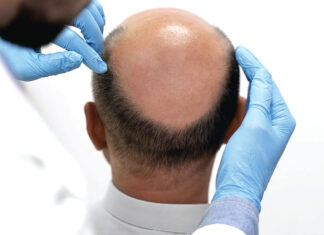 Alopécie : des mesures simples pour éviter la chute des cheveux