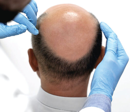 Alopécie : des mesures simples pour éviter la chute des cheveux