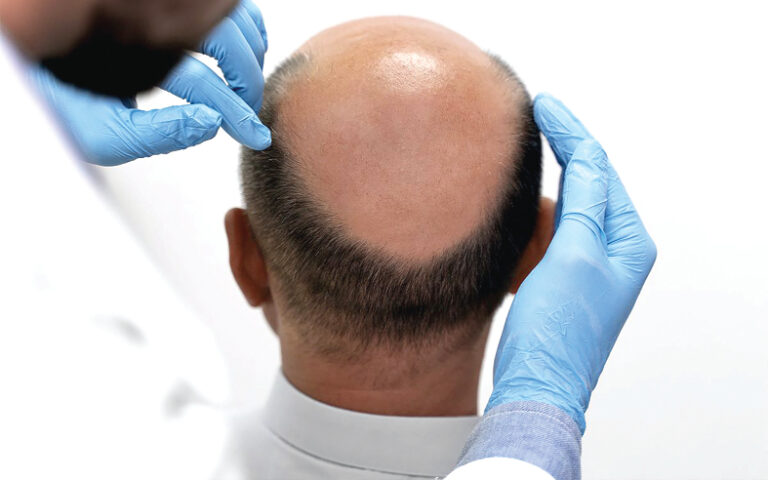 Alopécie : des mesures simples pour éviter  la chute des cheveux