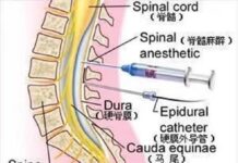 Sciences de la santé Les choses de l’anesthésie chirurgicale que vous devez savoir