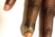 Panaris: l’usage d’antiseptiques est recommandé