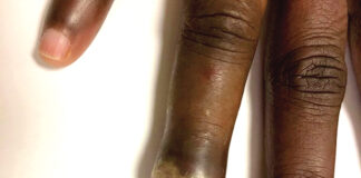 Panaris: l’usage d’antiseptiques est recommandé