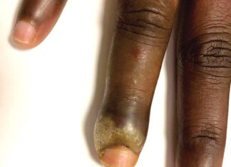 Panaris: l’usage d’antiseptiques est recommandé