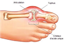 Goutte: les excès alimentaires aggravent la maladie