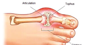 Goutte: les excès alimentaires aggravent la maladie